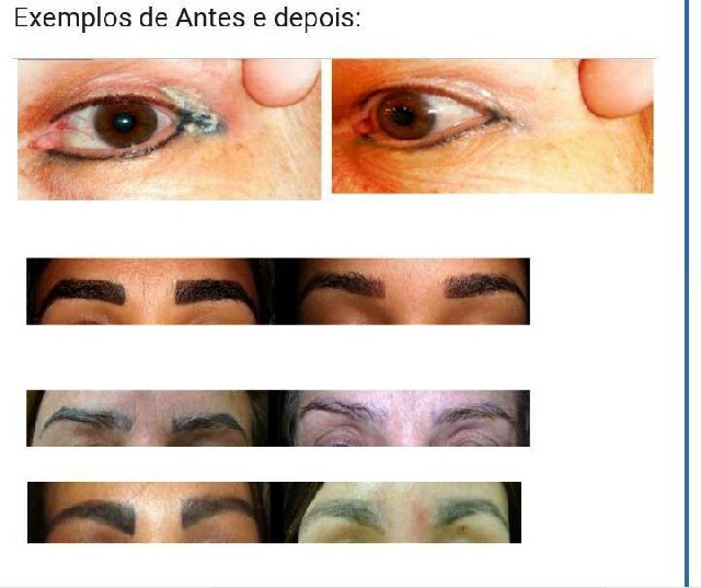 Despigmentação
